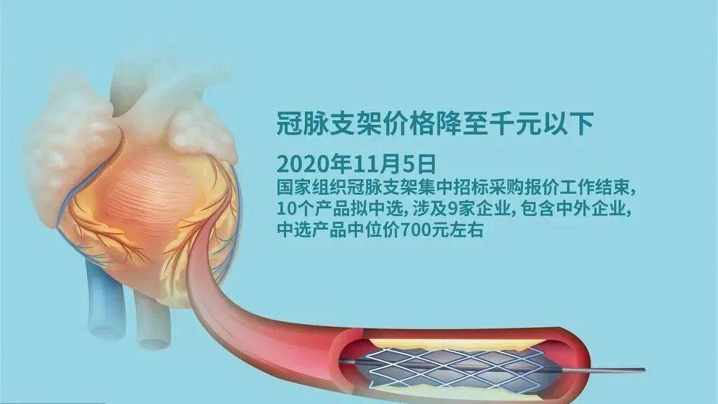 最新心脏支架技术，革新心脏健康的希望之光闪耀登场